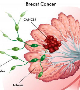 Breast Cancer treatment india