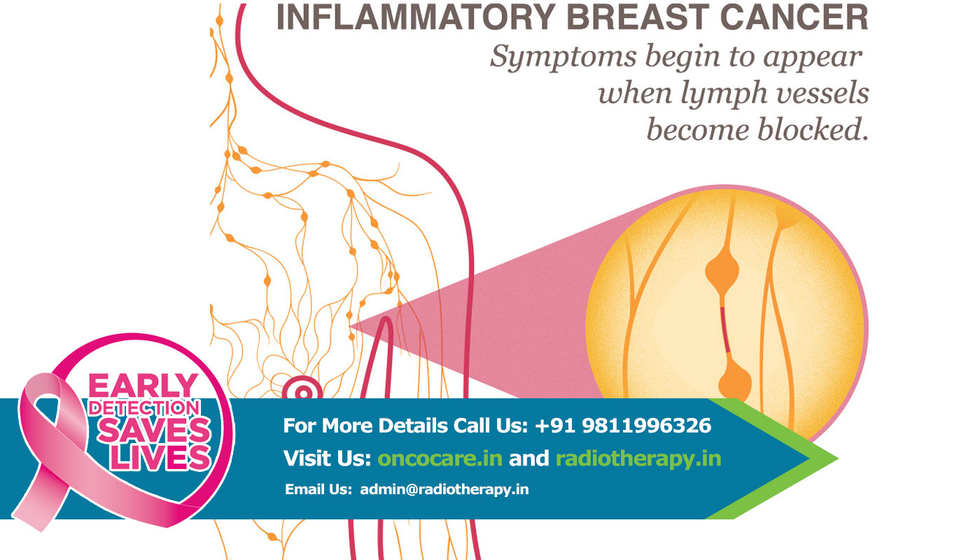 Breast Cancer Treatment in Delhi