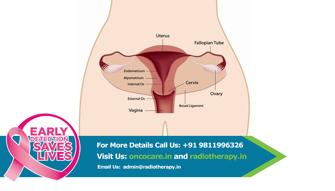 Best Cervix cancer Treatment india