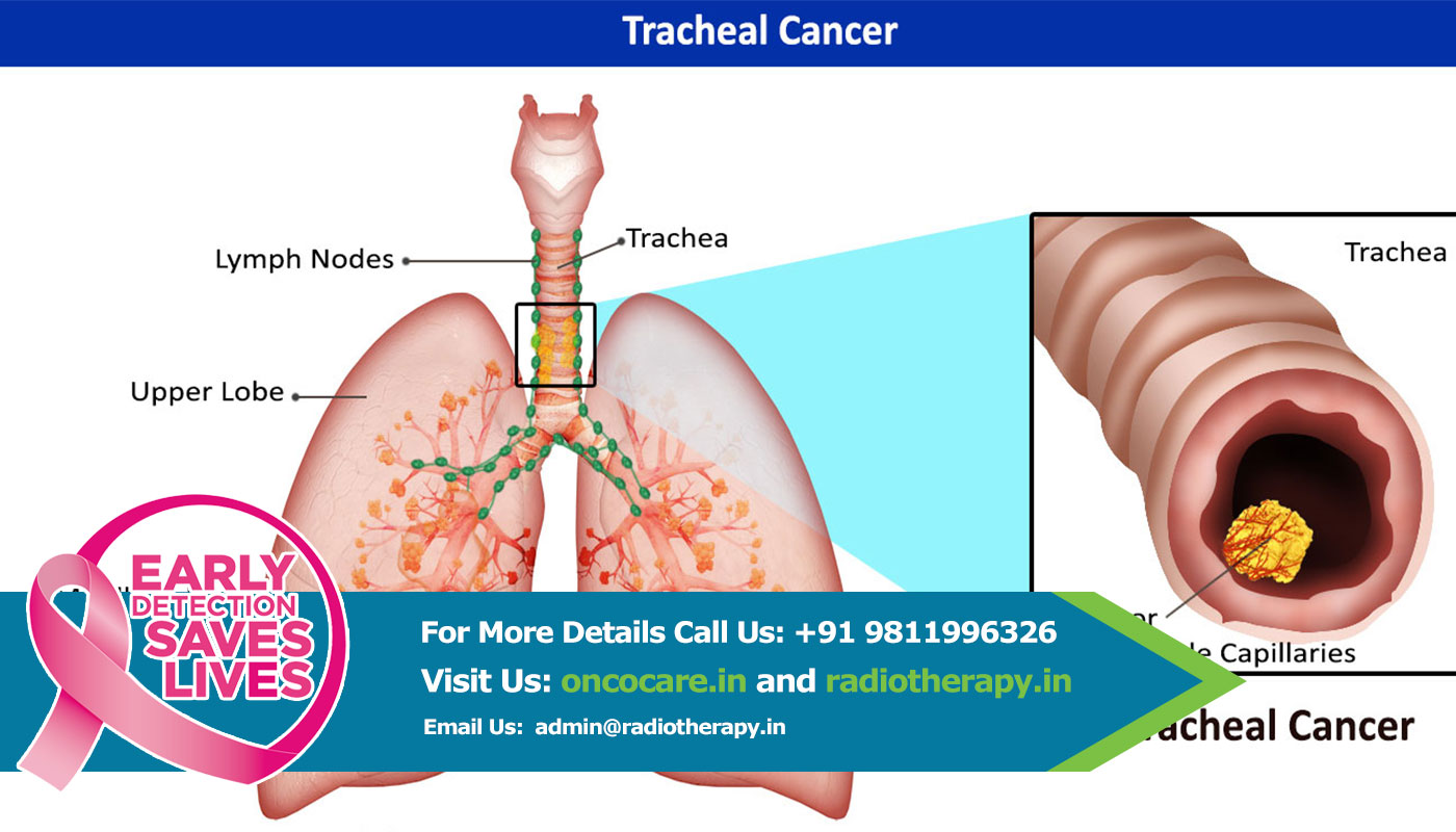 Stomach Cancer Treatment in India
